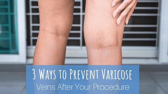 What should I do to prevent varicose veins from coming back?