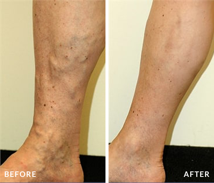 before and after vein treatment