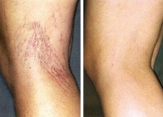 spider veins before and after