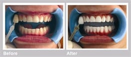 before and after teeth whitening procedure