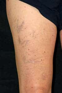 state 1 of vein disease