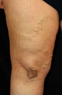 stage 2 of vein disease