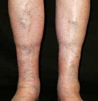 stage 3 of vein disease