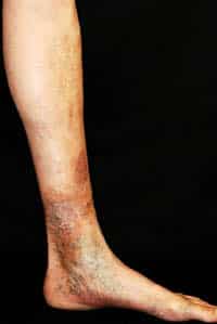 stage 4 of vein disease