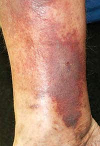 stage 5 of vein disease