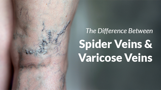 Spider vein help